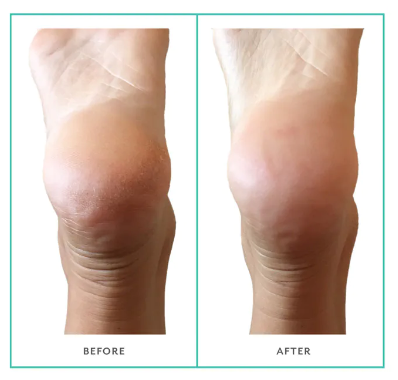 PoshPeel Pedicure Treatment